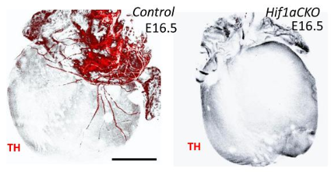 Dysregulated HIF-1α expression may contribute to cardiac dysfunction